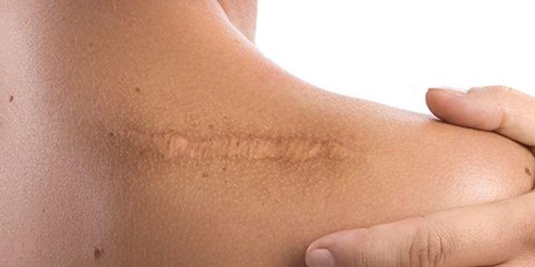 Камуфляж рубцов